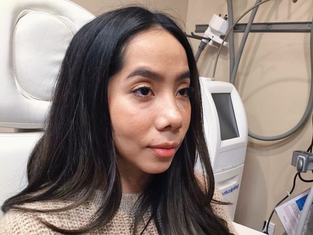 Under eye filler nuimage experience before after, Under Eye Fillers- My Experience at NuImage MedSpa in Paramus, NJ, Sandy Wears It